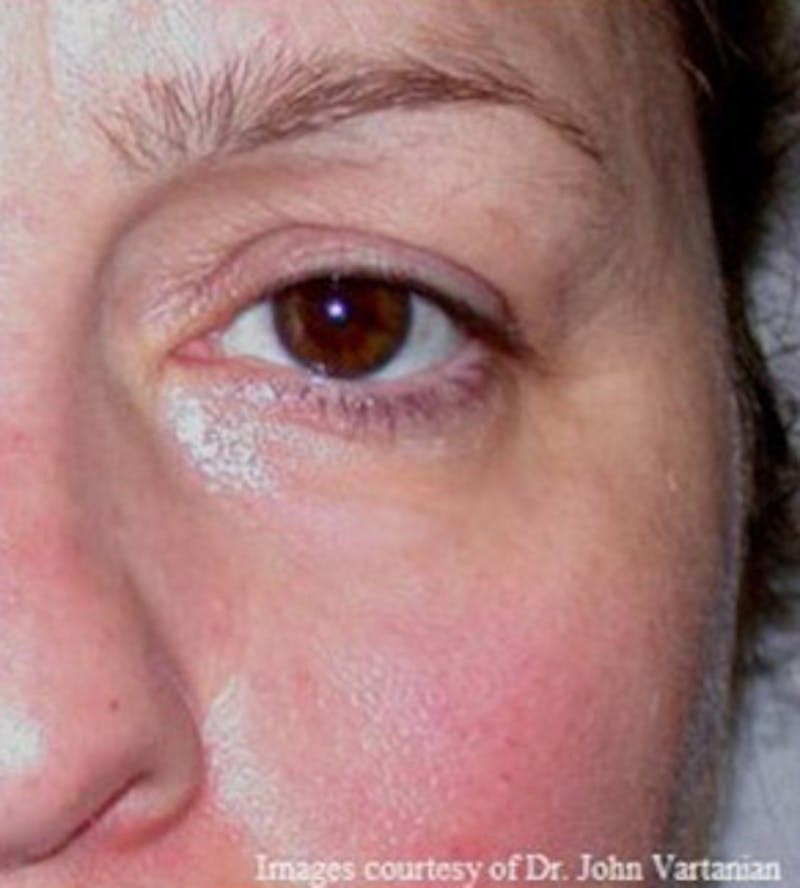 Non-Surgical Before & After Gallery - Patient 323882 - Image 2