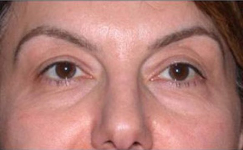 Non-Surgical Before & After Gallery - Patient 151341 - Image 1