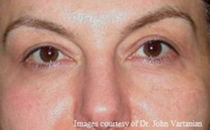 Non-Surgical Before & After Gallery - Patient 151341 - Image 2
