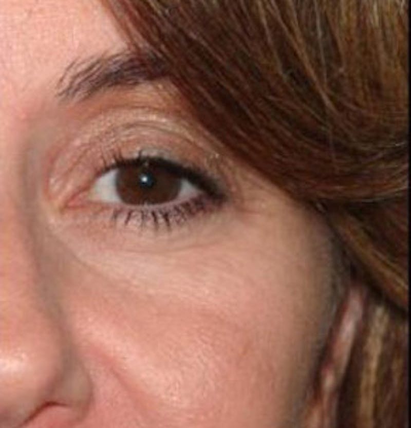 Non-Surgical Before & After Gallery - Patient 830046 - Image 1