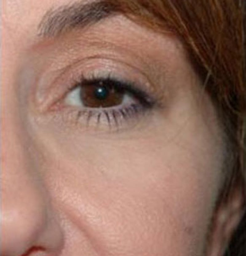 Non-Surgical Before & After Gallery - Patient 830046 - Image 2