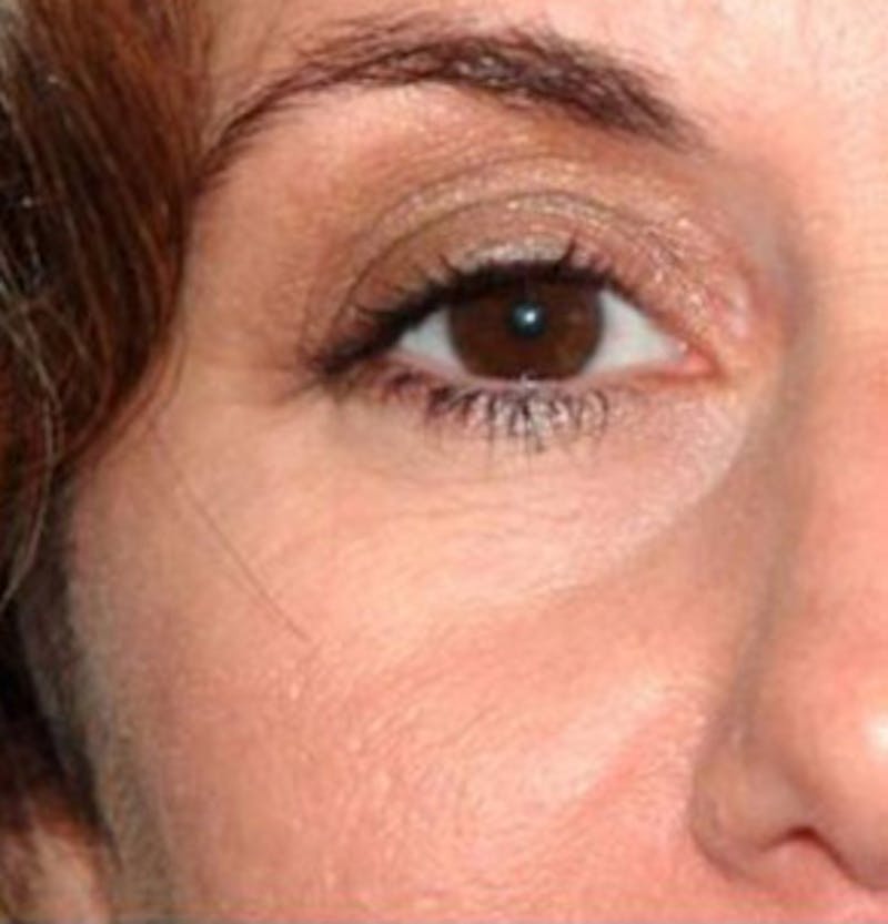 Non-Surgical Before & After Gallery - Patient 830046 - Image 3