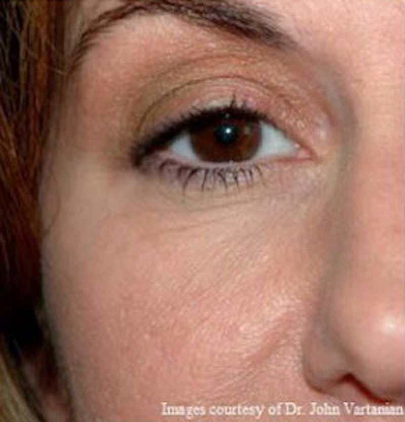 Non-Surgical Before & After Gallery - Patient 830046 - Image 4