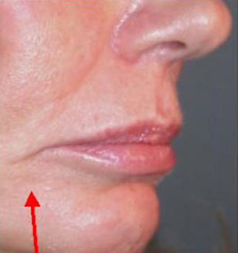 Non-Surgical Before & After Gallery - Patient 190413 - Image 1