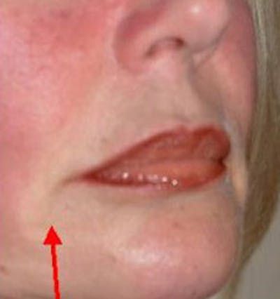 Non-Surgical Before & After Gallery - Patient 190413 - Image 2