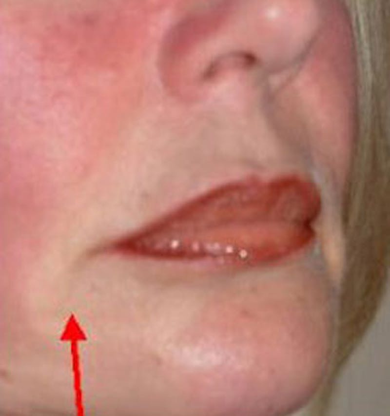Non-Surgical Before & After Gallery - Patient 190413 - Image 2