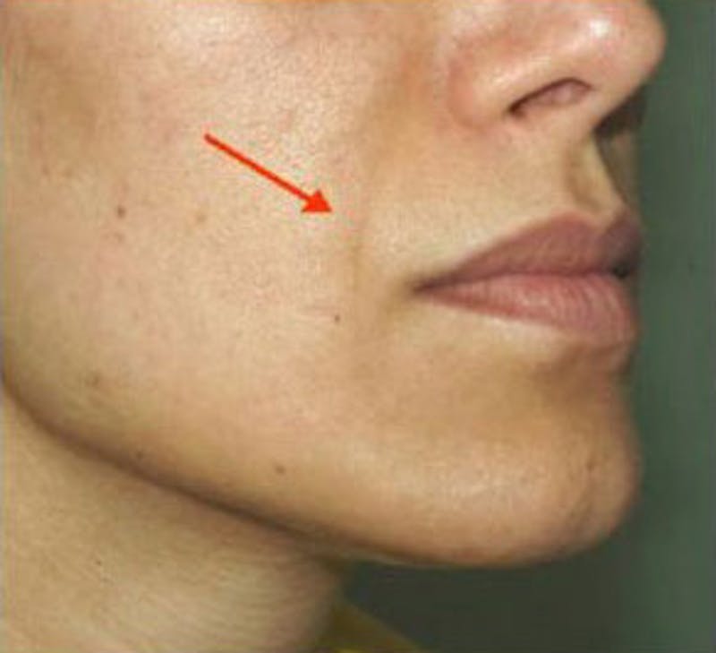Non-Surgical Before & After Gallery - Patient 180841 - Image 1