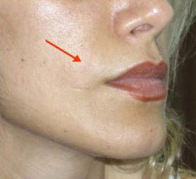 Non-Surgical Before & After Gallery - Patient 180841 - Image 2