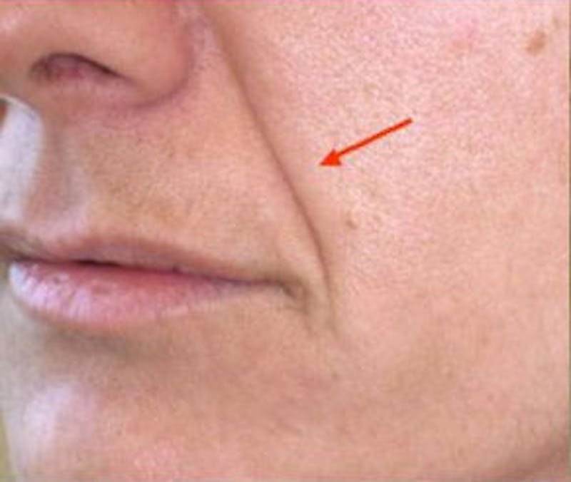 Non-Surgical Before & After Gallery - Patient 284158 - Image 1