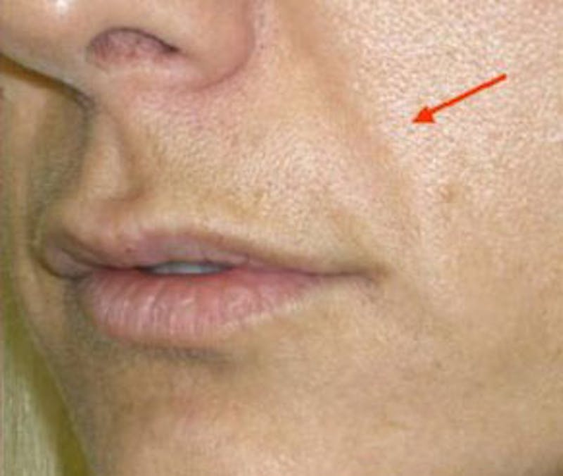 Non-Surgical Before & After Gallery - Patient 284158 - Image 2