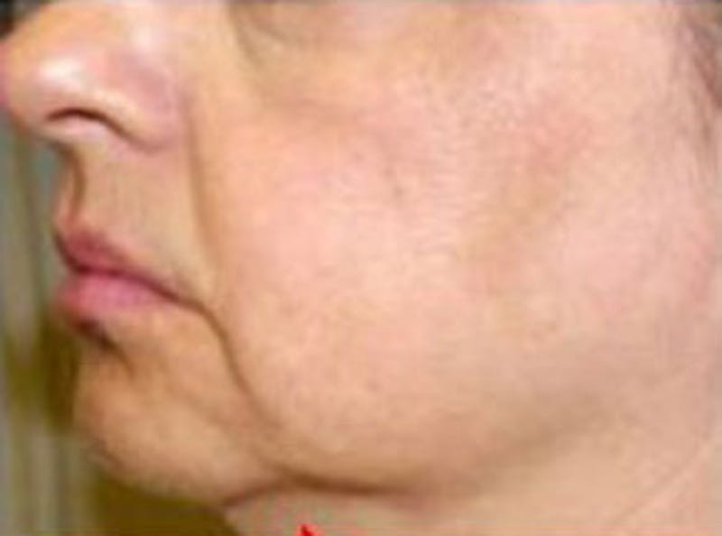 Non-Surgical Before & After Gallery - Patient 321014 - Image 1