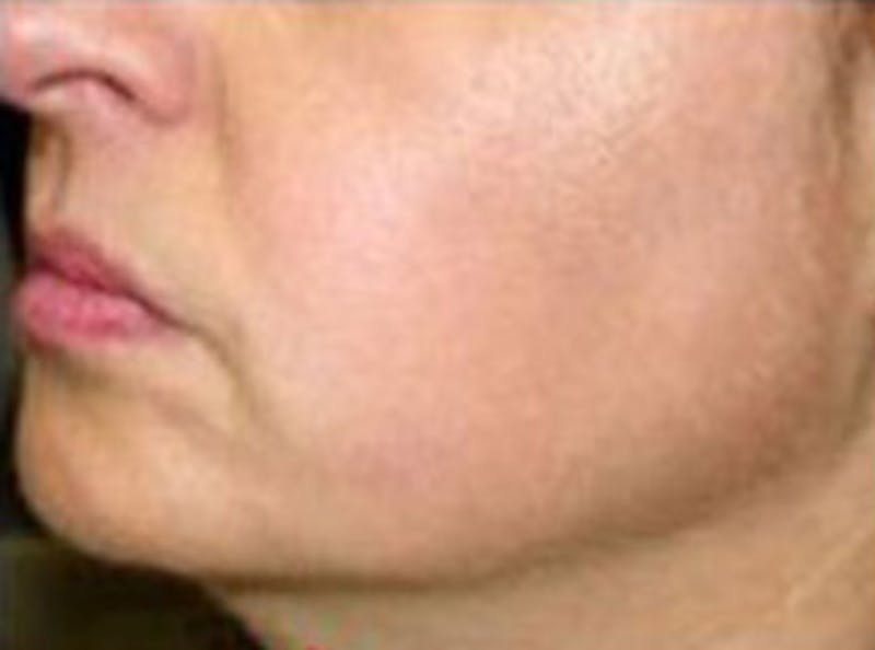 Non-Surgical Before & After Gallery - Patient 321014 - Image 2