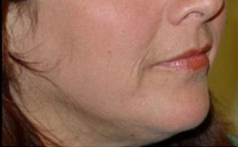 Non-Surgical Before & After Gallery - Patient 122843 - Image 1