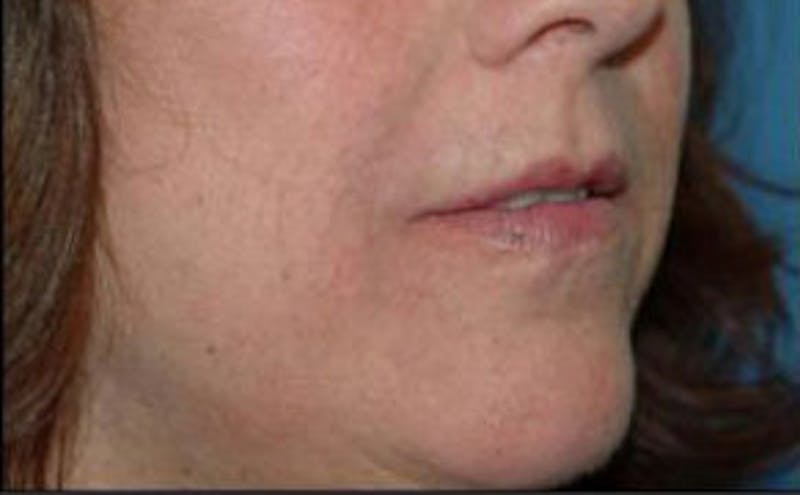 Non-Surgical Before & After Gallery - Patient 122843 - Image 2