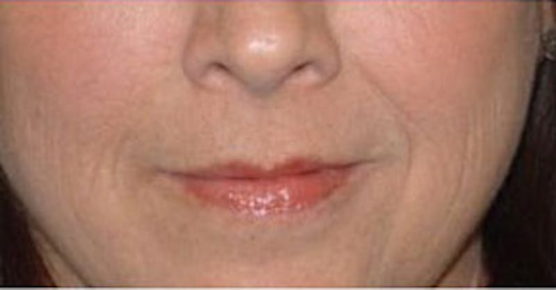 Non-Surgical Before & After Gallery - Patient 151960 - Image 1
