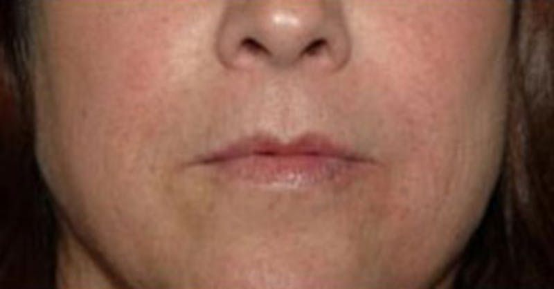 Non-Surgical Before & After Gallery - Patient 151960 - Image 2