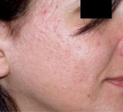 Non-Surgical Before & After Gallery - Patient 420272 - Image 1