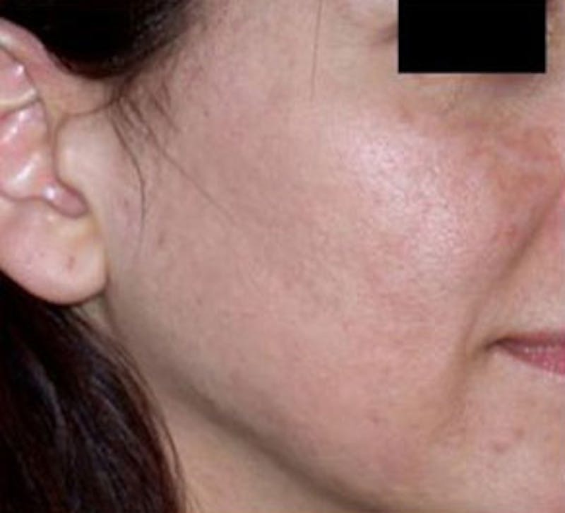 Non-Surgical Before & After Gallery - Patient 420272 - Image 2