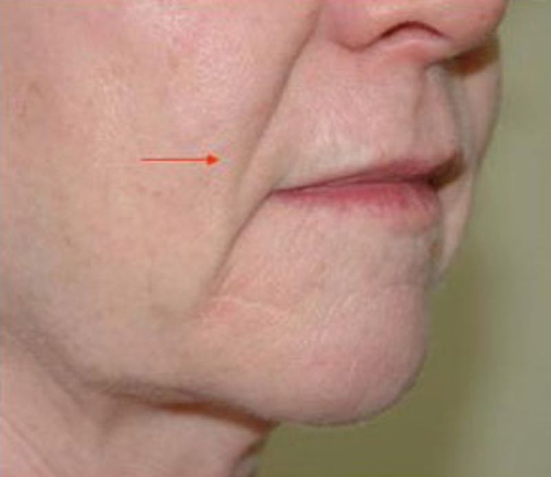 Non-Surgical Before & After Gallery - Patient 261246 - Image 1