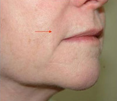 Non-Surgical Before & After Gallery - Patient 261246 - Image 2