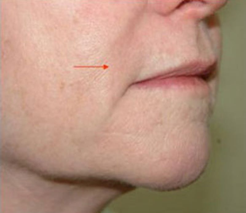 Non-Surgical Before & After Gallery - Patient 261246 - Image 2