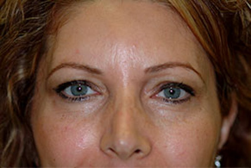 Non-Surgical Before & After Gallery - Patient 303549 - Image 1