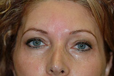 Non-Surgical Before & After Gallery - Patient 303549 - Image 2