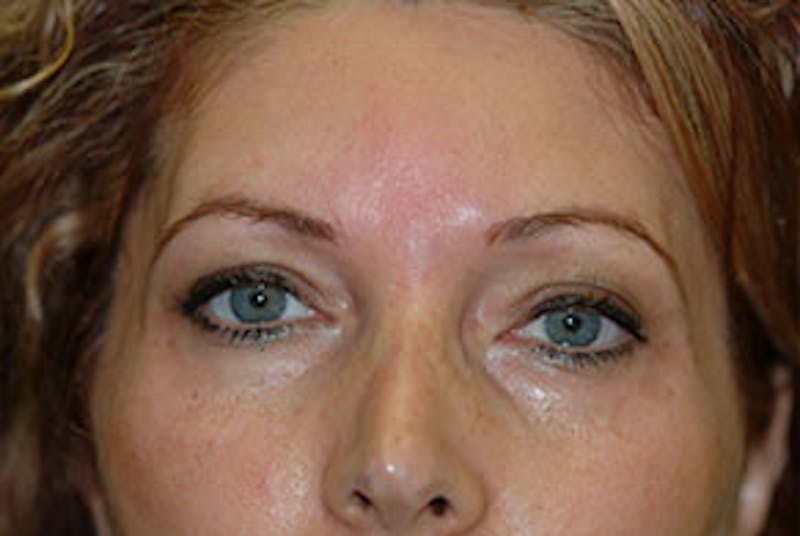 Non-Surgical Before & After Gallery - Patient 303549 - Image 2