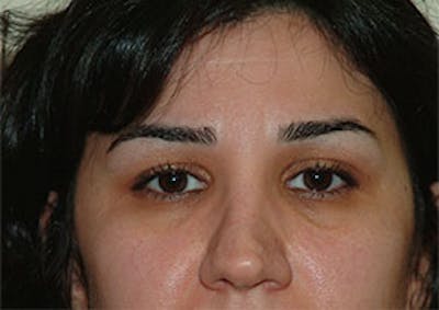 Non-Surgical Before & After Gallery - Patient 385741 - Image 1