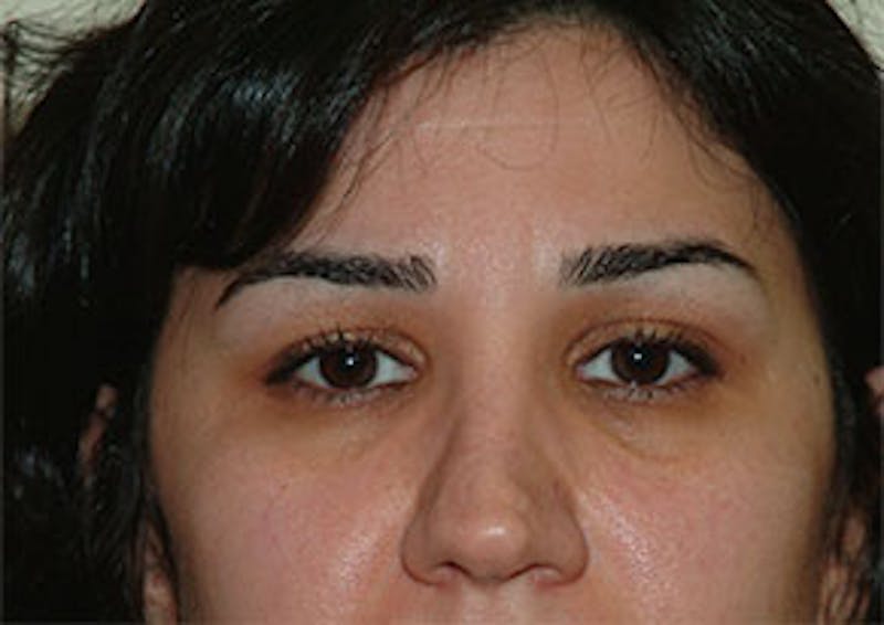 Non-Surgical Before & After Gallery - Patient 385741 - Image 1