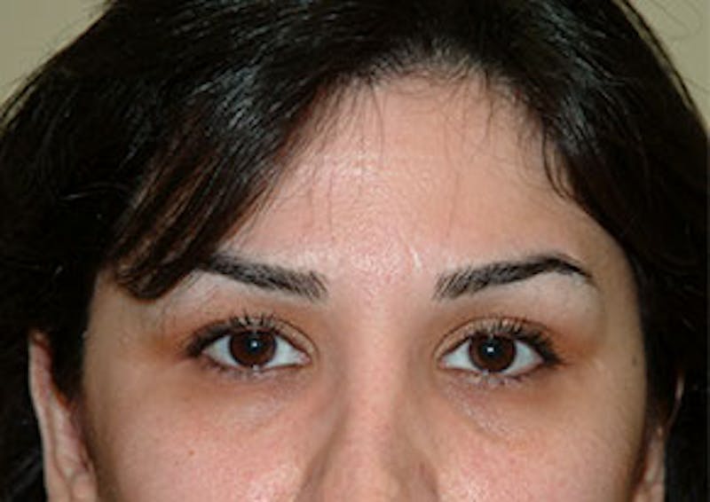 Non-Surgical Before & After Gallery - Patient 385741 - Image 2