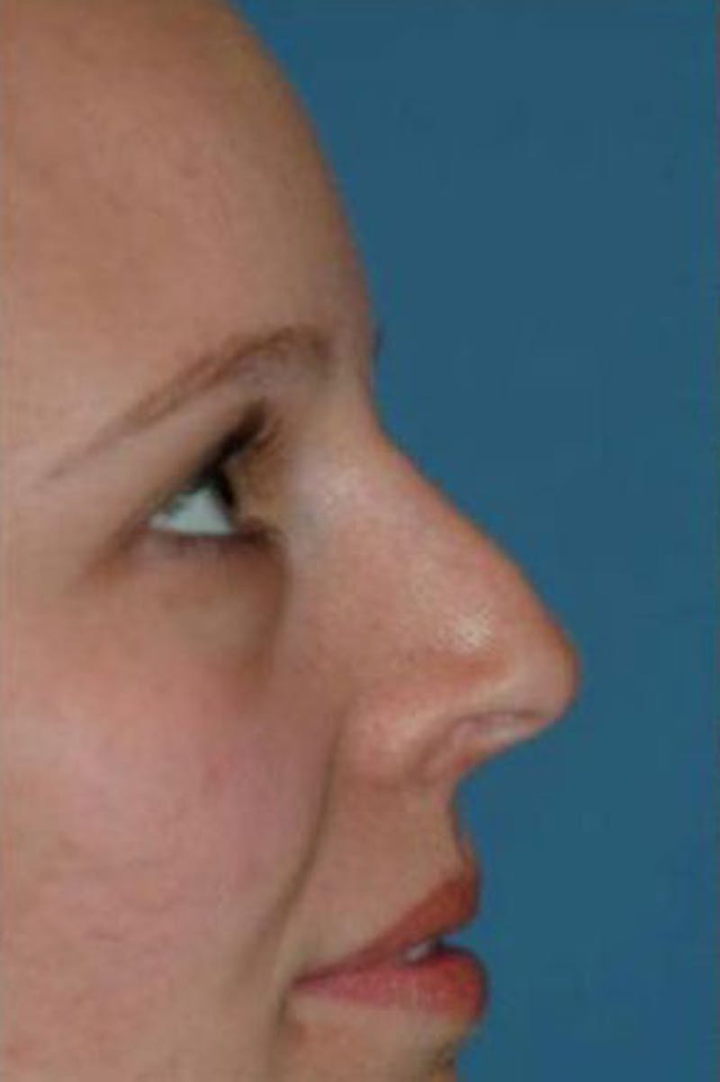 Rhinoplasty Before & After Gallery - Patient 224194 - Image 1