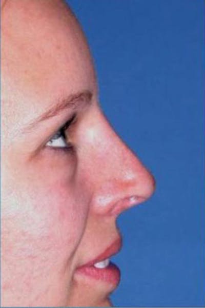 Rhinoplasty Before & After Gallery - Patient 224194 - Image 2