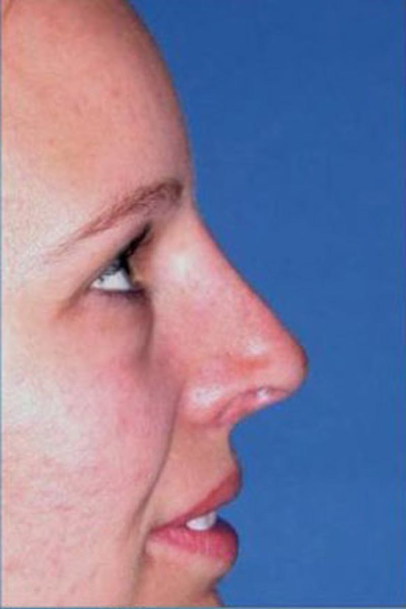 Rhinoplasty Before & After Gallery - Patient 224194 - Image 2