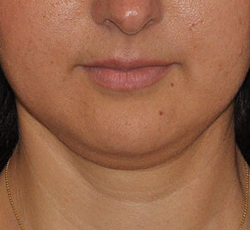 Surgical Before & After Gallery - Patient 186405 - Image 1
