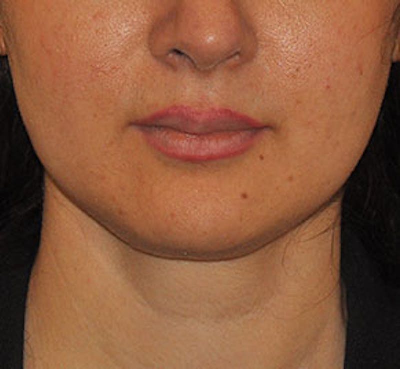 Surgical Before & After Gallery - Patient 186405 - Image 2