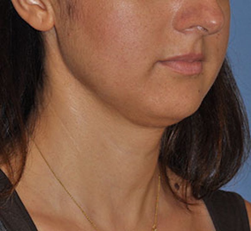 Surgical Before & After Gallery - Patient 186405 - Image 3