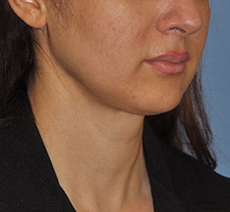 Surgical Before & After Gallery - Patient 186405 - Image 4