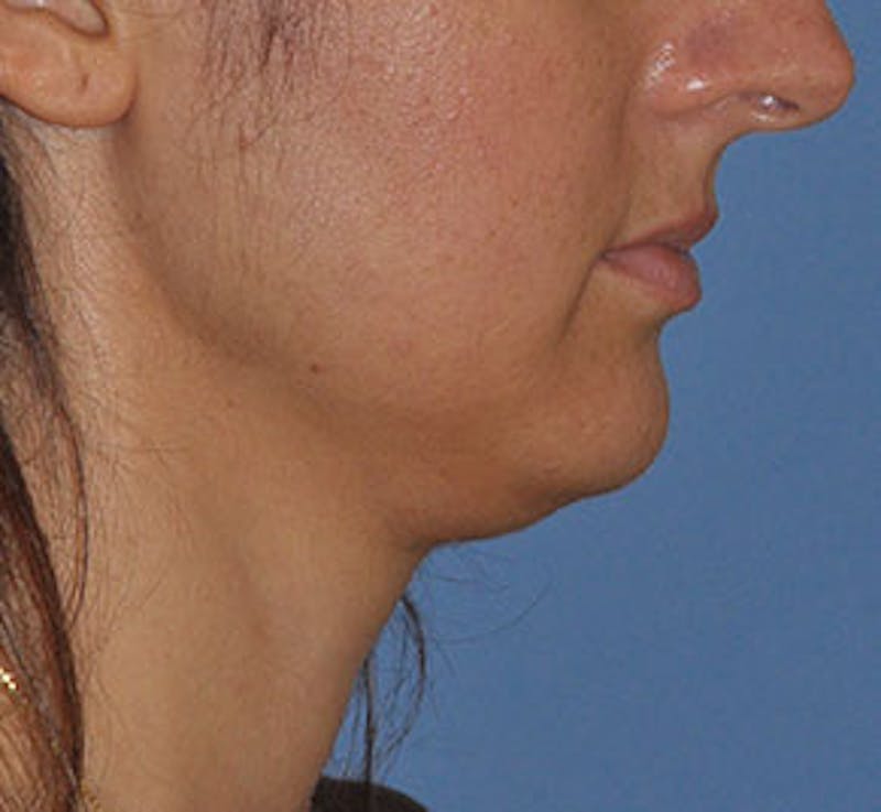 Surgical Before & After Gallery - Patient 186405 - Image 5