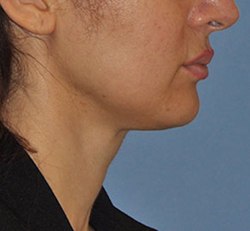 Surgical Before & After Gallery - Patient 186405 - Image 6