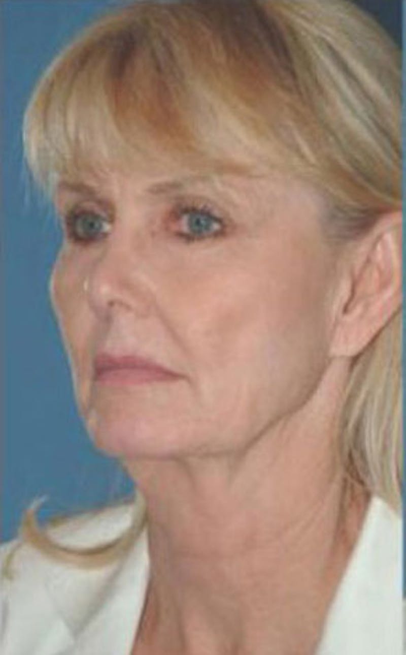 Surgical Before & After Gallery - Patient 189392 - Image 3