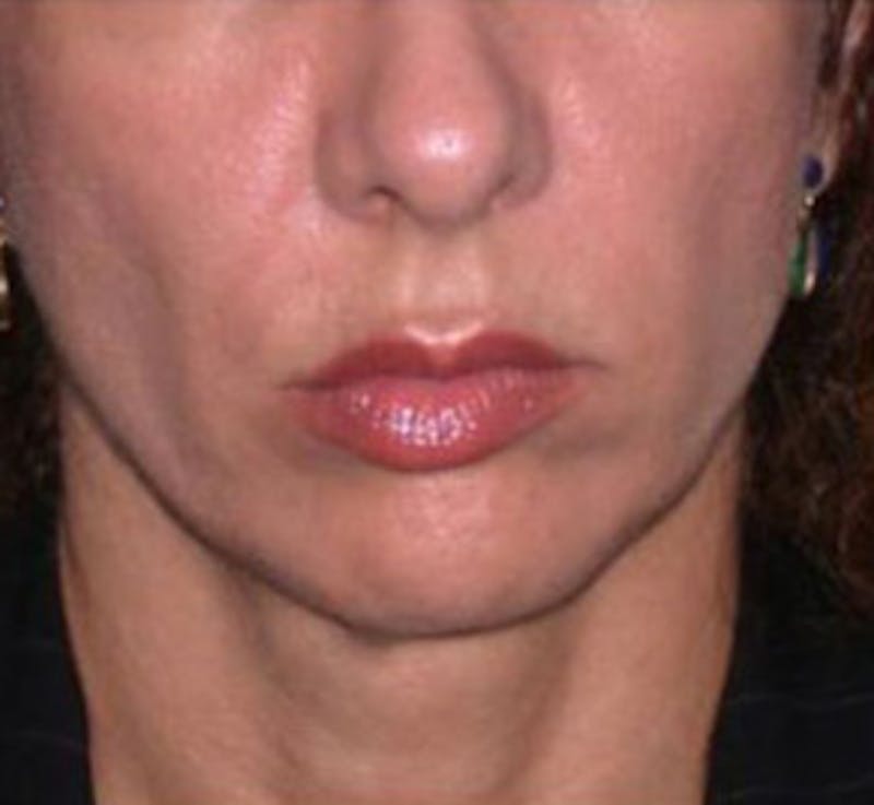 Surgical Before & After Gallery - Patient 839159 - Image 1