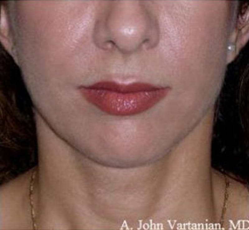 Surgical Before & After Gallery - Patient 839159 - Image 2