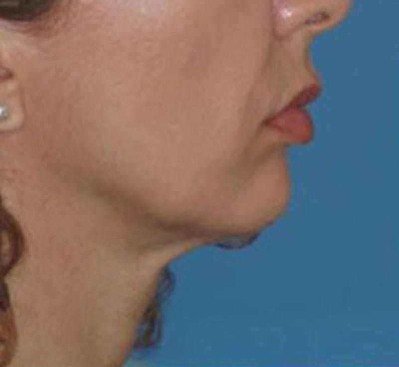 Surgical Before & After Gallery - Patient 839159 - Image 3