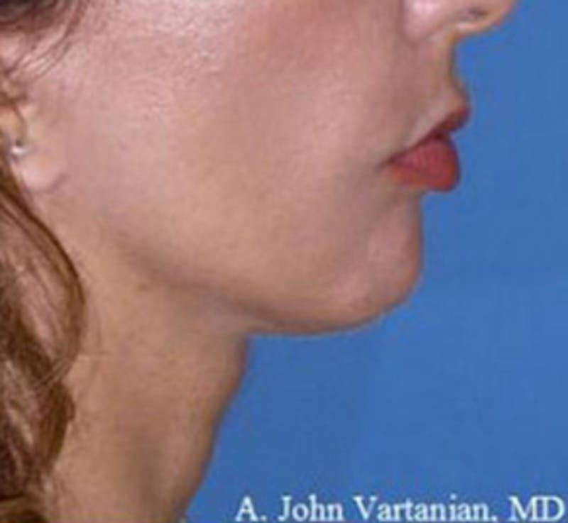 Surgical Before & After Gallery - Patient 839159 - Image 4