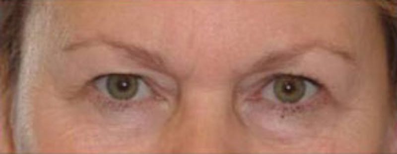 Surgical Before & After Gallery - Patient 815161 - Image 1