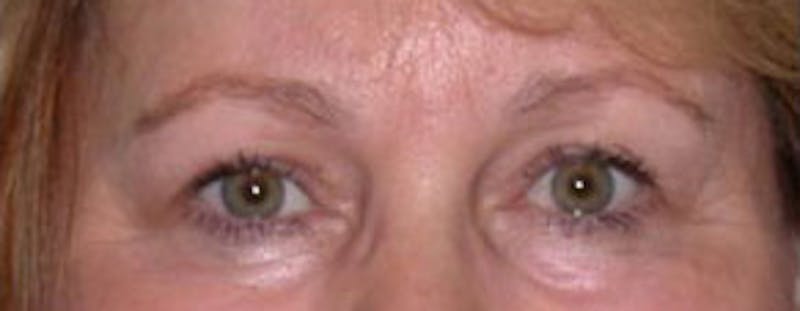 Surgical Before & After Gallery - Patient 815161 - Image 2