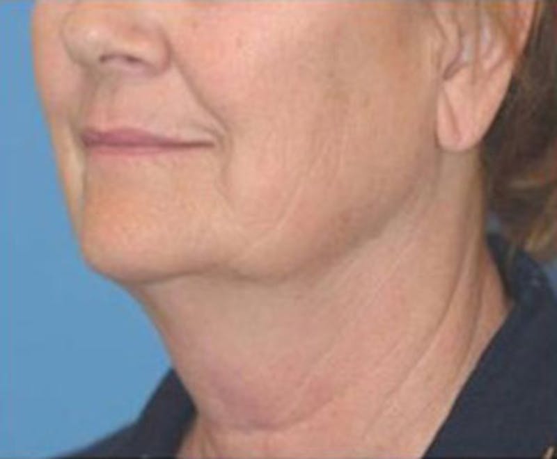 Surgical Before & After Gallery - Patient 329546 - Image 1