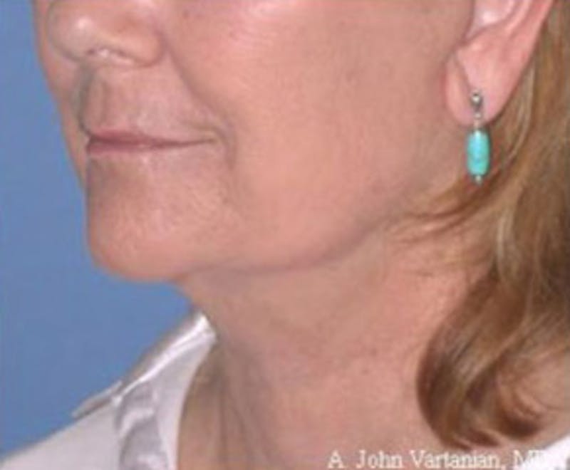 Surgical Before & After Gallery - Patient 329546 - Image 2