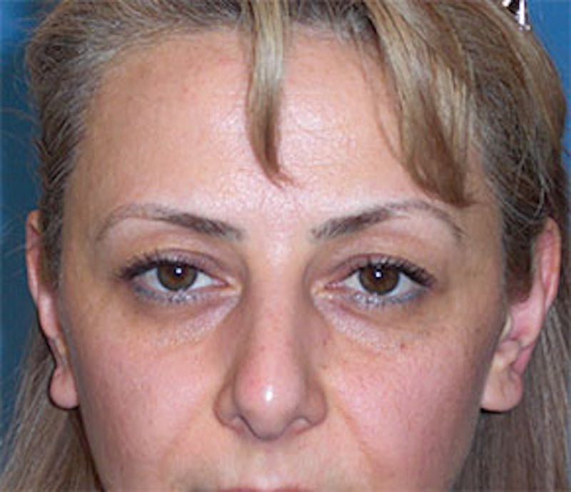 Surgical Before & After Gallery - Patient 223505 - Image 1